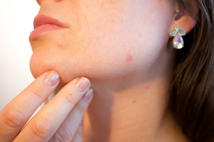 Cibi da evitare per non incorrere nell'acne